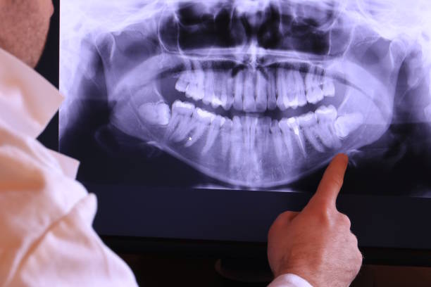 Best Knocked-Out Tooth (Avulsed Tooth) Treatment in Seagoville, TX